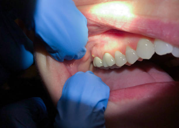 Best Broken or Cracked Tooth Emergency Dentist in Tega Cay, SC